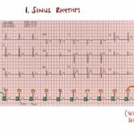 Most Common ECG Patterns You Should Know
