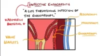 Infective Endocarditis (With Duke Criteria & Pathophysiology)