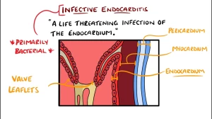 Infective Endocarditis (With Duke Criteria & Pathophysiology)