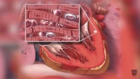 Mayo Clinic Minute What is pericarditis