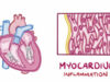 Myocarditis – causes, symptoms, diagnosis, treatment, pathology