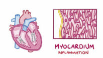 Myocarditis – causes, symptoms, diagnosis, treatment, pathology