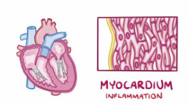 Myocarditis – causes, symptoms, diagnosis, treatment, pathology