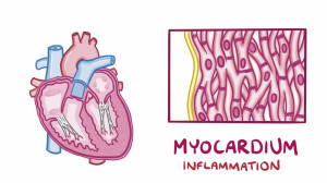 Myocarditis – causes, symptoms, diagnosis, treatment, pathology