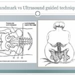 Ultrasound Guided Lumbar Puncture