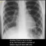 Chest x-ray , pneumonia
