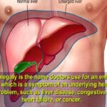 How Do You Treat Hepatomegaly (Enlarged Or Swollen Liver)