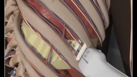How To- Ultrasound Guided Thoracentesis Exam 3D Video