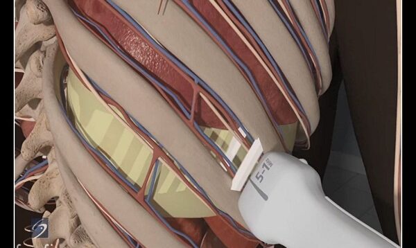 How To- Ultrasound Guided Thoracentesis Exam 3D Video