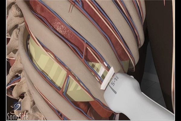 How To- Ultrasound Guided Thoracentesis Exam 3D Video