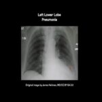 Lobar Pneumonia Chest X-rays