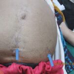 Paracentesis #Ascitic tap