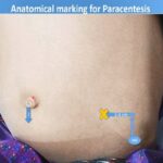 Paracentesis or Ascitic Tap - Pediatrics