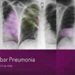 Lobar Pneumonia: Chest X-ray Atlas