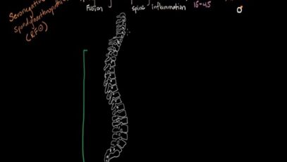 Ankylosing spondylitis – Muscular-skeletal diseases
