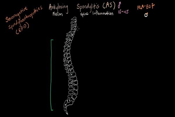 Ankylosing spondylitis – Muscular-skeletal diseases