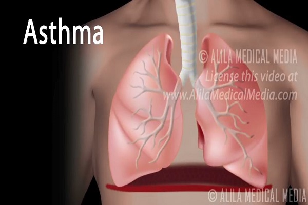 Asthma, Animation