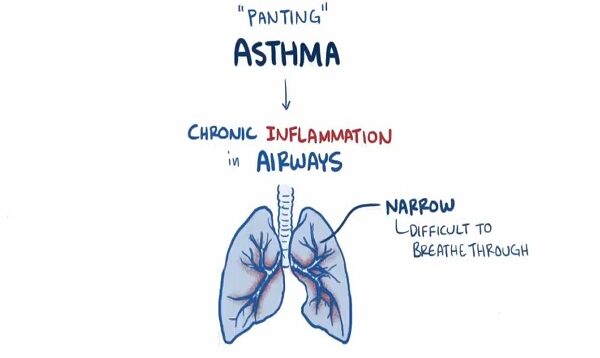 Asthma – causes, symptoms, diagnosis, treatment, pathology