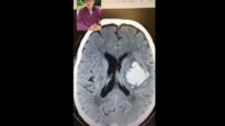 Brain Surgeon Explains CT Scan!