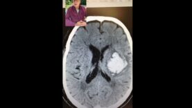 Brain Surgeon Explains CT Scan!