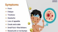 Chicken Pox- Symptoms, Causes, Prevention and Treatment