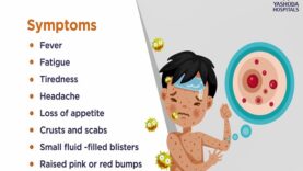 Chicken Pox- Symptoms, Causes, Prevention and Treatment