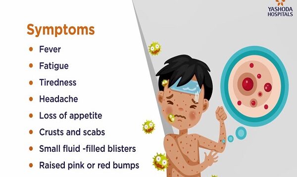 Chicken Pox- Symptoms, Causes, Prevention and Treatment
