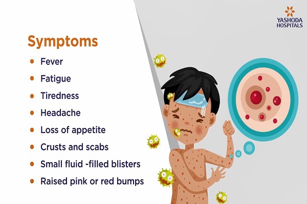 Chicken Pox- Symptoms, Causes, Prevention and Treatment