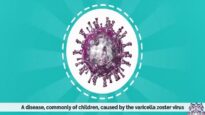 Chickenpox, Causes, Signs and Symptoms, Diagnosis and Treatment.