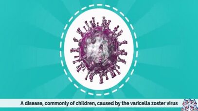 Chickenpox, Causes, Signs and Symptoms, Diagnosis and Treatment.