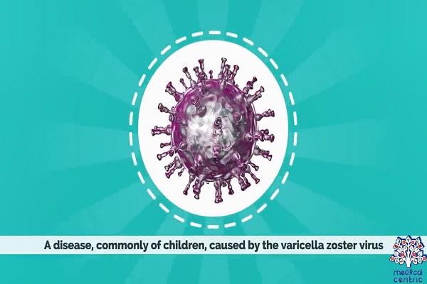 Chickenpox, Causes, Signs and Symptoms, Diagnosis and Treatment.