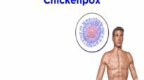 Chickenpox and Shingles (Varicella-Zoster Virus)