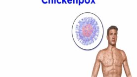 Chickenpox and Shingles (Varicella-Zoster Virus)