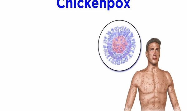 Chickenpox and Shingles (Varicella-Zoster Virus)