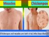 Chickenpox vs Measles- Which is Which.