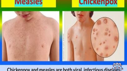 Chickenpox vs Measles- Which is Which.