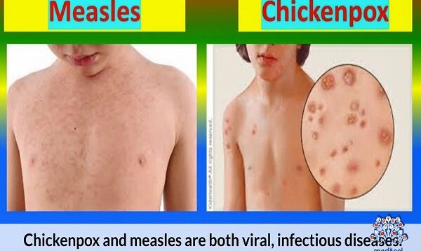 Chickenpox vs Measles- Which is Which.