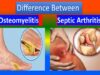 Distinction between Osteomyelitis and Septic Arthriti