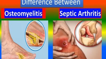 Distinction between Osteomyelitis and Septic Arthriti