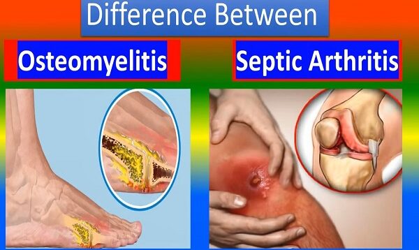 Distinction between Osteomyelitis and Septic Arthriti