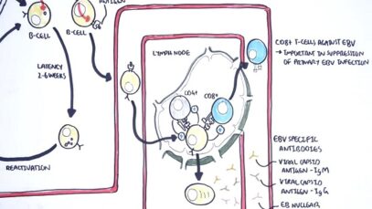 Epstein Barr Virus and Infectious Mononucleosis (pathophysiology, investigations and treatment)