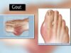 Gout
