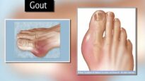 Gout