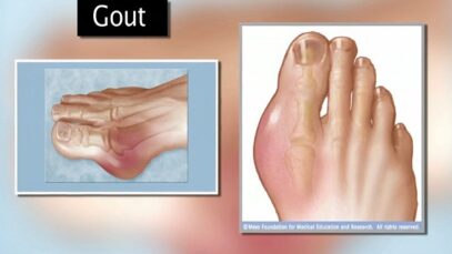 Gout