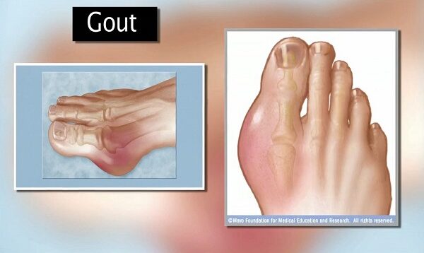 Gout
