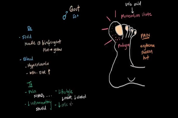 Gout and pseudogout _ Muscular-skeletal diseases