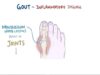 Gout – causes, symptoms, diagnosis, treatment, pathology