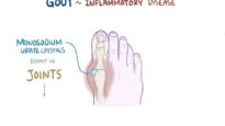Gout – causes, symptoms, diagnosis, treatment, pathology
