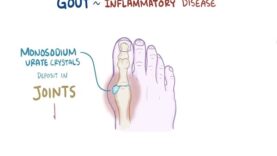 Gout – causes, symptoms, diagnosis, treatment, pathology