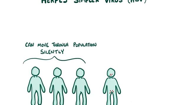 Herpes (oral genital) – causes, symptoms, diagnosis, treatment, pathology